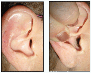 otevreni-zvukovodu-pred-zavedenim-chranicu-sluchu